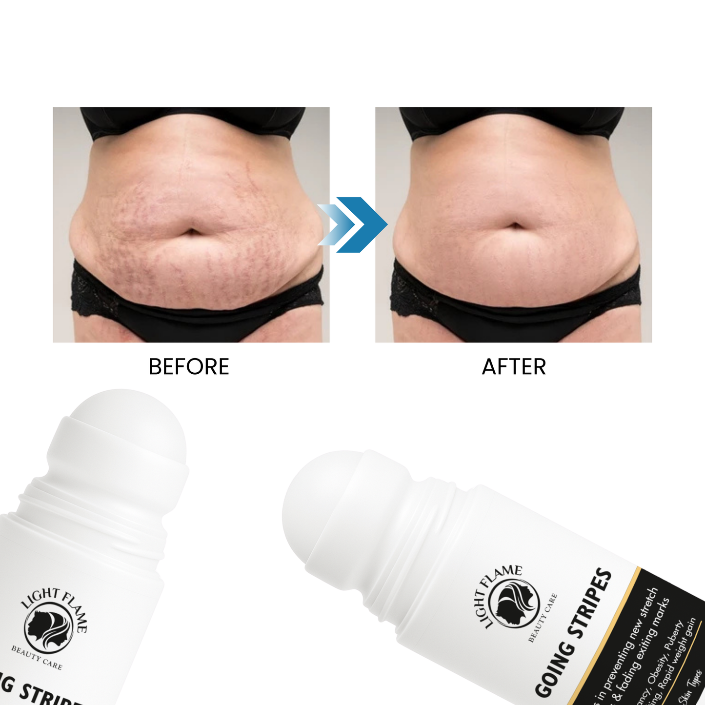 Going Stripes – 3-Week Intense Stretch Mark Eraser | Light Flame Beauty Care
